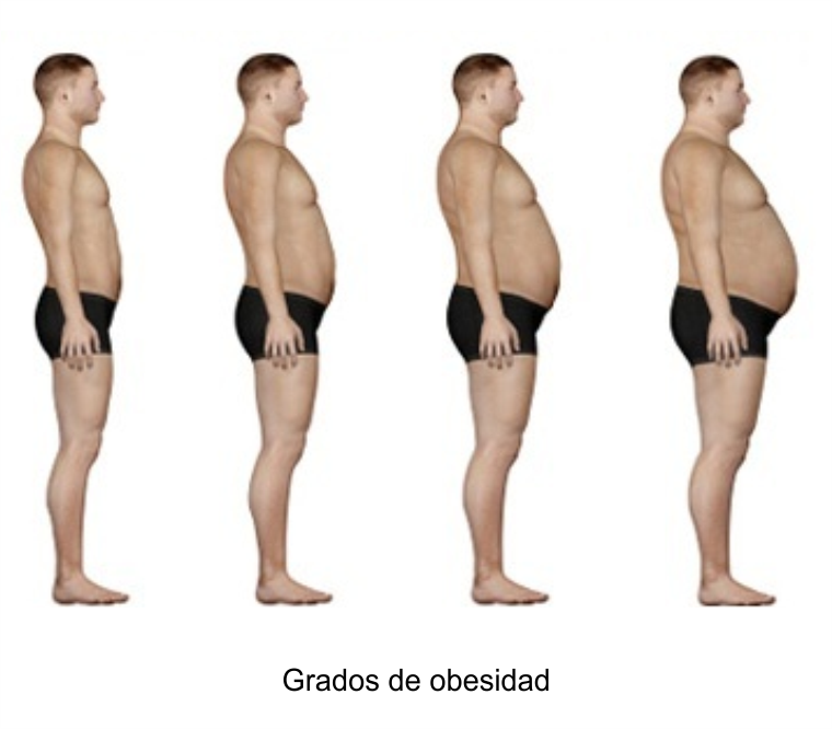 grados de obesidad